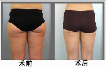 臀部吸脂