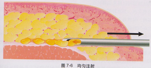 5,钝针注射