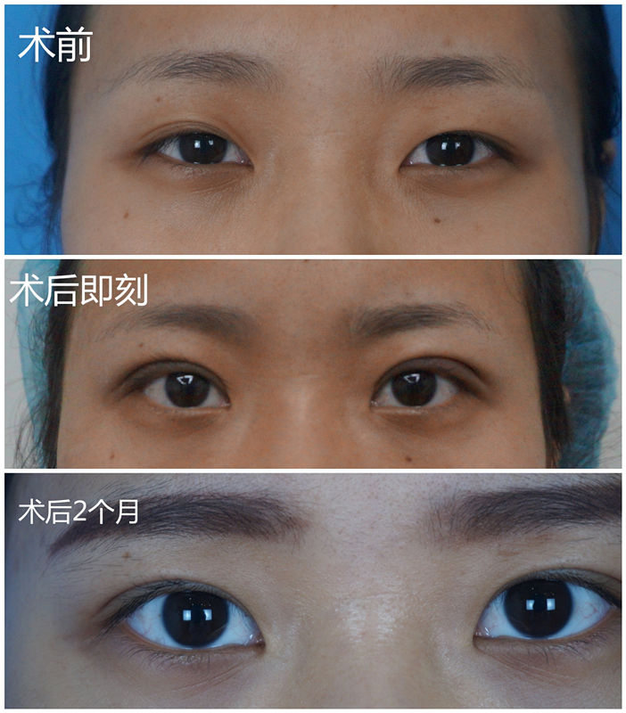 Ϻ˫ƤǮ,˫Ƥ,Ϻ˫ƤҽԺ